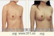 副乳手术多少钱,全面解析费用构成与影响因素