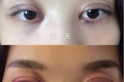 双眼皮埋线多少钱,价格因素与全面解析