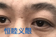 植入义眼费用全解析：价格因素与性价比选择指南