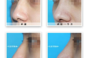 缩小鼻头多少钱-全面解析鼻部整形手术价格与价值