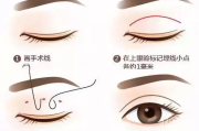 割双眼皮多少钱,价格构成与影响因素全面解析