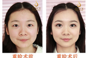 韩式三点双眼皮多少钱-价格构成与影响因素全面解析