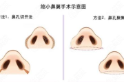 鼻翼缩小多少钱,价格构成与影响因素全面解析
