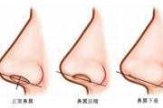鼻头缩小多少钱？全面解析鼻头缩小手术价格与影响因素