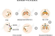 耳软骨隆鼻多少钱,费用构成与性价比分析