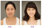 隆胸手术多少钱？全面解析隆胸价格构成与影响因素