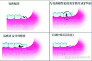 拔智齿一颗牙多少钱：全面解析智齿拔除费用与影响因素