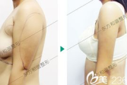 手臂抽脂多少钱,价格构成与影响因素全面解析