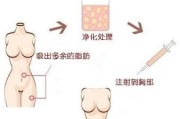 自体脂肪丰胸价格全解析：影响费用的关键因素与价值评估