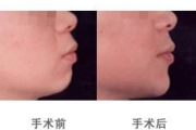 玻尿酸下巴多少钱,价格影响因素与性价比分析