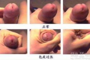 割包皮一般多少钱？全面解析包皮环切手术费用与影响因素