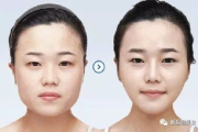瘦脸针价格全解析：影响瘦脸针要多少钱的关键因素