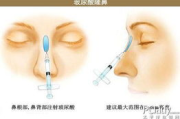 注射玻尿酸需要多少钱,价格构成与影响因素全面解析