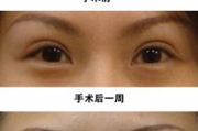 一般做双眼皮多少钱,价格构成与影响因素全面解析