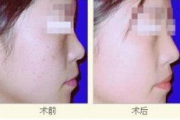 激光嫩肤需要多少钱-价格构成与影响因素全面解析