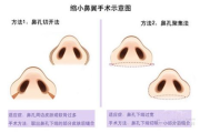 隆鼻需要多少钱,全面解析影响隆鼻价格的因素与预算规划