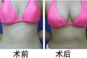 隆胸手术一般多少钱,费用构成与影响因素解析