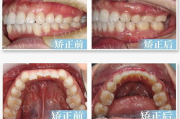 牙齿矫正多少钱,全面解析矫正费用与影响因素
