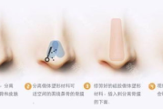 鼻尖整形大概多少钱,全面解析价格因素与选择指南