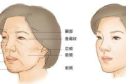 填充太阳穴价格全解析：材料选择与影响因素详解