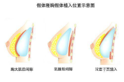 假体隆胸手术多少钱,全面解析价格构成与影响因素