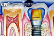 种植牙齿多少钱一个,费用构成与影响因素全面解析