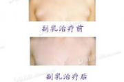 副乳手术需要多少钱,价格构成与影响因素全面解析