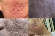 激光去痘印多少钱,全面解析价格构成与性价比考量