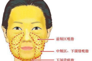 面部吸脂多少钱,价格构成与影响因素全面解析