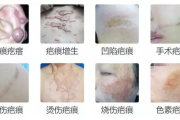 医院去疤痕一般多少钱,费用因素与治疗方式解析